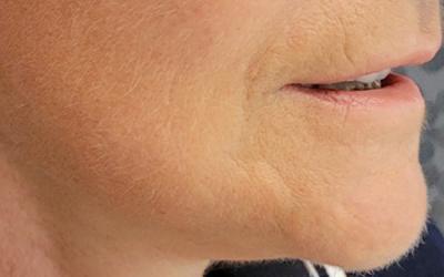 Patient 1 -lifting cervico facial après