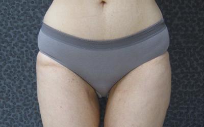 Liposuccion après