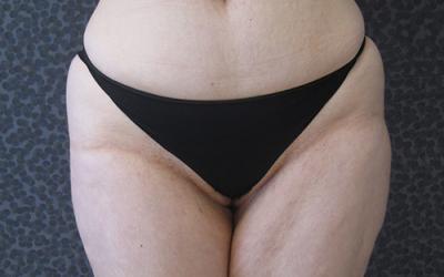 Liposuccion avant