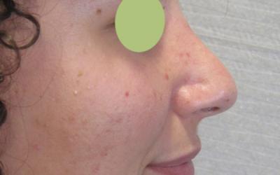 Patiente 1 - Rhinoplastie après