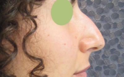 Patiente 1 - Rhinoplastie avant