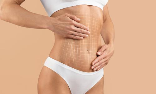 Abdominoplastie