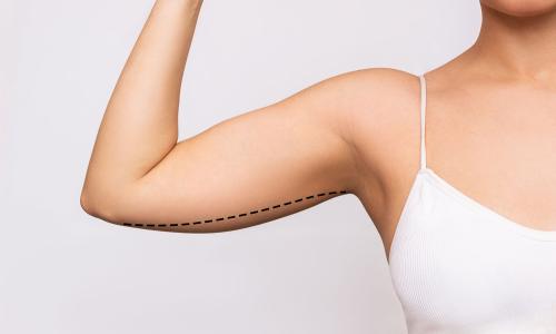 Lifting des bras
